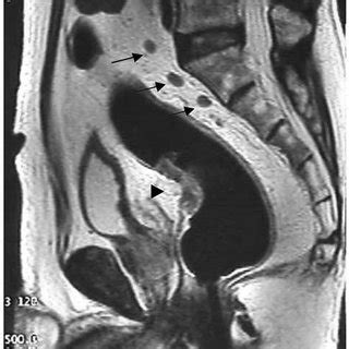 (PDF) MRI diagnosis of mesorectal lymph node metastasis in patients ...