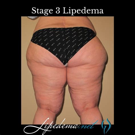 Learn About Stages and Types of Lipedema | Lipedema.net