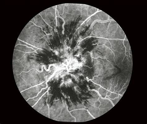 FA Early Phase Optic Disc Edema - Retina Image Bank