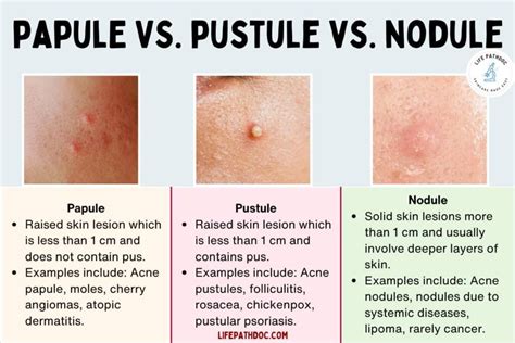 Papule vs Pustule vs Nodule: Pictures, Differences, and Causes