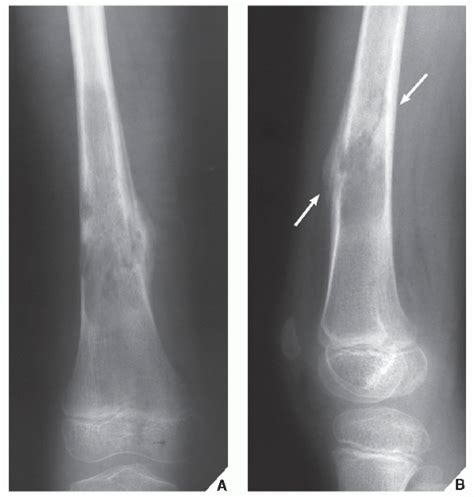 Malignant Bone Tumors I: Osteosarcomas and Chondrosarcomas | Radiology Key