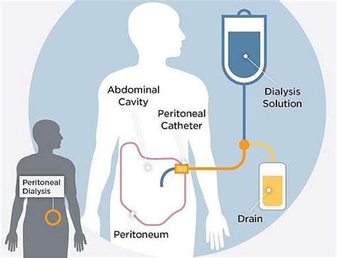 Peritoneal Dialysis: Principles, Procedure, Advantages