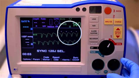 R Series Synchronized Cardioversion (Software prior to v 14) - YouTube