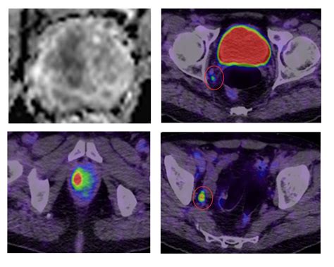 PSMA PET Imaging — Professor Declan Murphy