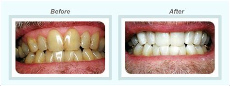 A Brief Introduction About The Teeth Whitening Procedure