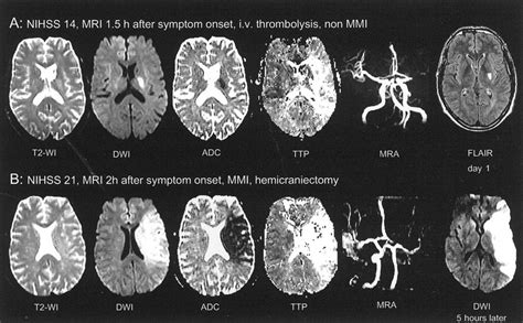 Middle Cerebral Artery Stroke Treatment - Pregnant Health Tips