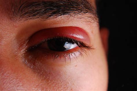 Herpes zóster en el ojo: síntomas, tratamiento y prevención - Salud - Tudo