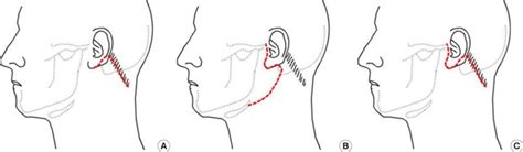 Types of incsion for parotid tumor. (A) Retroauricular hair line ...