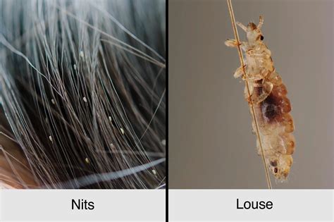 A Guide to Head Lice: Symptoms, Treatments, Prevention | The Healthy