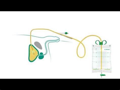 Suprapubic Catheter: How to use - YouTube