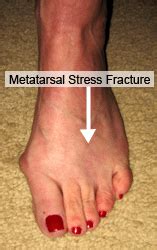 Metatarsal Stress Fractures | PTI Orthotics | Boulder Longmont