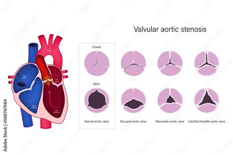 Vetor de Valvular aortic stenosis. Normal aortic valve, Bicuspid aortic ...