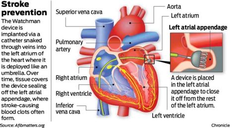 MAPMG Cardiologists Perform New Watchman Procedure, Reduce Risk of ...