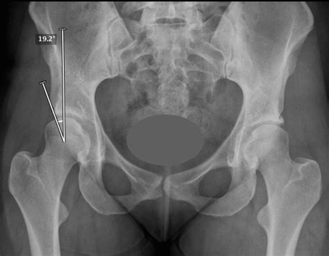 Options for symptomatic hip dysplasia in adults - BallaratOSM ...