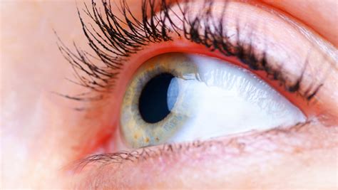 Corneal Erosion Causes & Treatment from Global Contact Lens Specialists