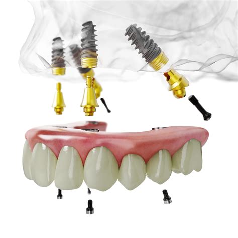 All About the Innovative All-on-4 Dental Implant Procedure