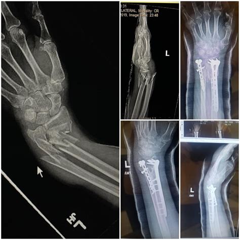 Complex open ulna & radius fracture. 2 months, 2 plates, 16 screws ...