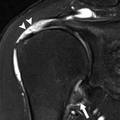 MRI pinpoints shoulder stiffness from rotator cuff tears