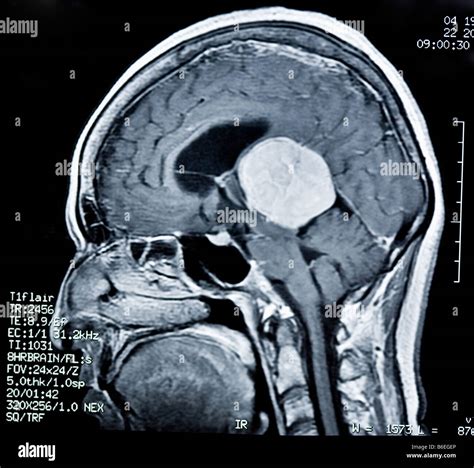 Brain Mri Scan Tumor