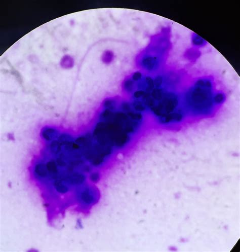 PLEURAL FLUID CYTOLOGY