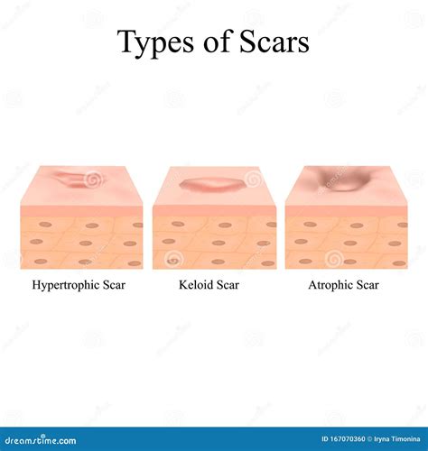 Types of Scars. Acne Scars. Keloid, Hypertrophic, Atrophic ...