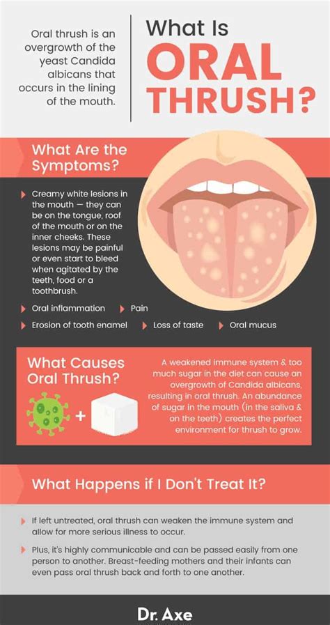 Oral Thrush Symptoms, Causes, Treatment, Prevention - Dr. Axe