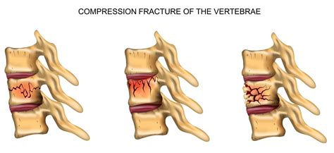 Spinal Fractures: Types, Causes, Symptoms, Diagnosis, and Treatments ...