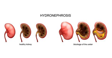 Hydronephrosis - Dr. Heidi Stephany