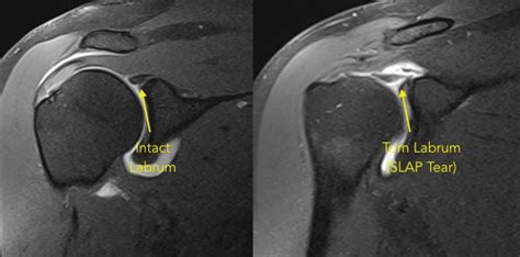 SLAP Tears and Biceps Tendon Injuries — Huang Orthopaedics