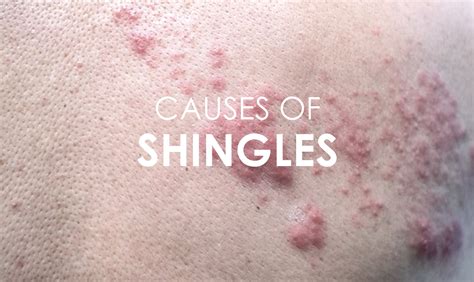 Shingles Rash On Chest