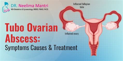 Tubo Ovarian Abscess: Symptoms Causes... - Dr Neelima Mantri