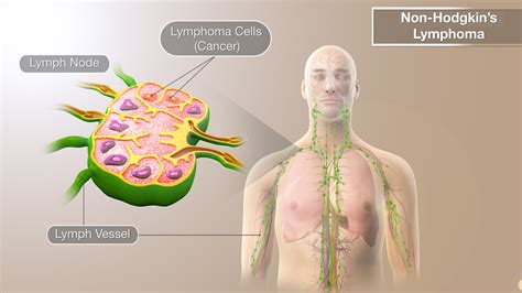 Non-Hodgkin's Lymphoma Shown & Explained Using Medical Animation