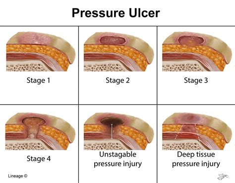 Stage 3 Pressure Ulcer - 1 - This wound often includes undermining and ...