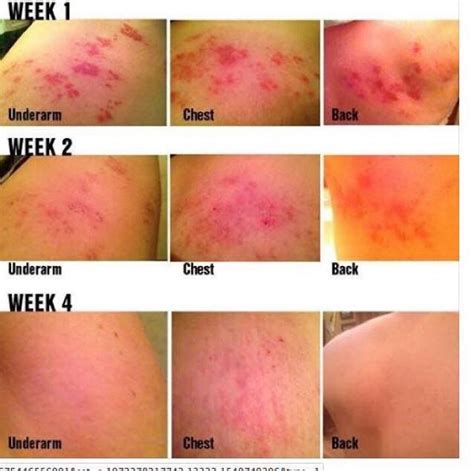 Shingles!!! Rodan and Fields Soothe Regimen has this affect on shingles ...