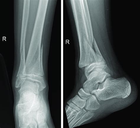 Pre-operative radiographs of the right ankle triplane fracture. A ...