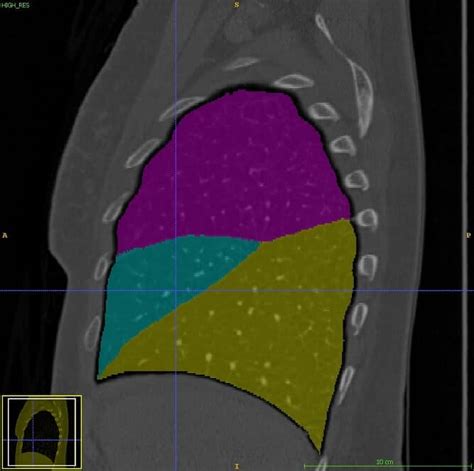 Lung lobes Segmentation in CT Scans by RSIP Vision