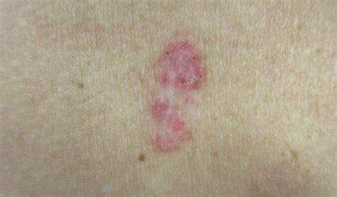 Basal Cell Carcinoma | ISCN