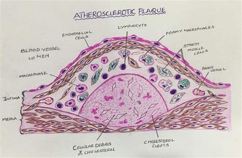 MORPHOLOGY OF ATHEROSCLEROSIS – Histopathology.guru