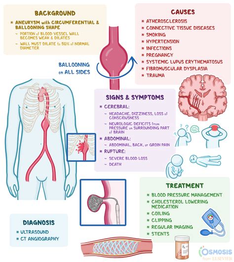 Fusiform Aneurysm: What Is It, Causes, Treatment, and More | Osmosis