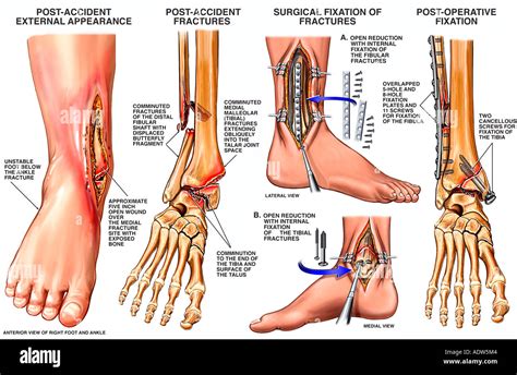 Tibia And Fibula Compound Fracture