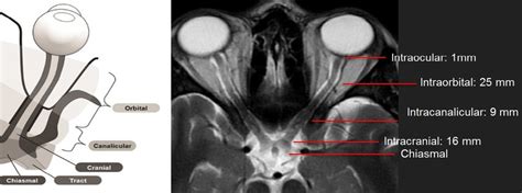 Mri Eye Anatomy