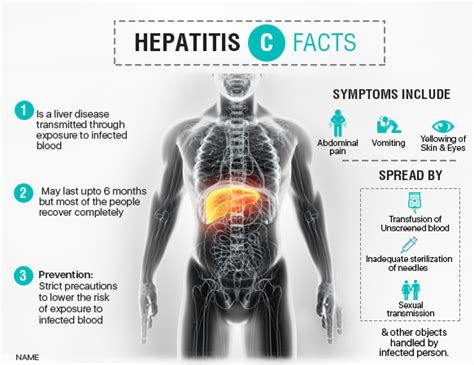 Hepatitis C