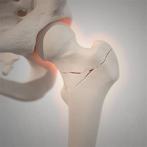 Bone Fracture Types and Symptoms | Globus Medical