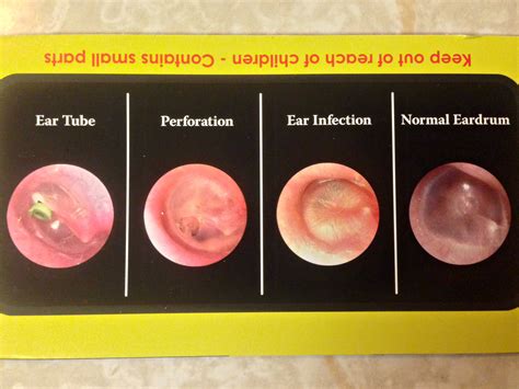 Inner Ear Infection Otoscope