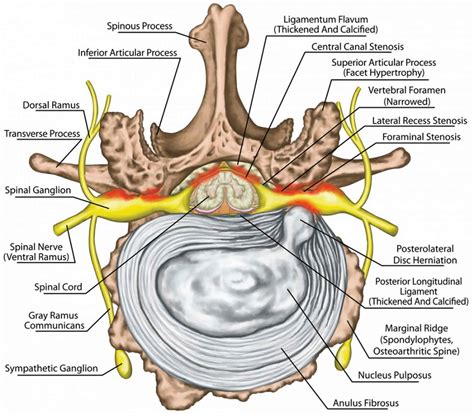 Neural foraminal stenosis causes, symptoms, diagnosis, treatment ...