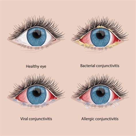 Allergic Conjunctivitis Discharge