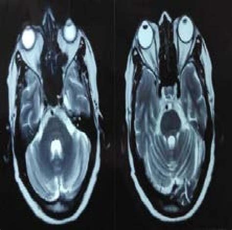 MRI of brain and orbit (Axial) showing increased right optic nerve ...