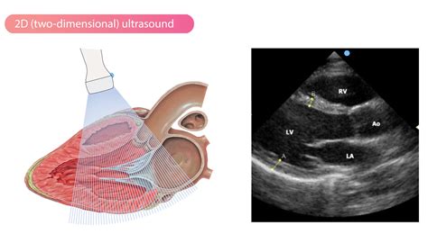 Two-dimensional (2D) echocardiography – Cardiovascular Education