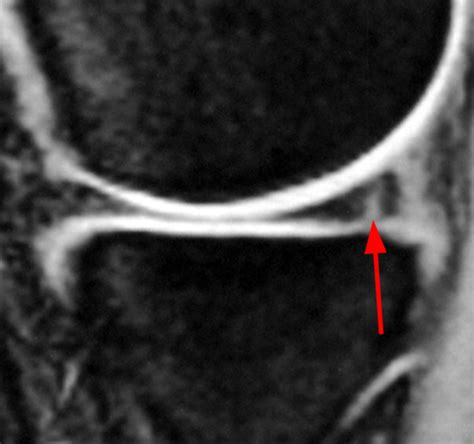 Meniscal Tear Patterns | Radsource