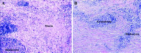 Granuloma Annulare Histopathology